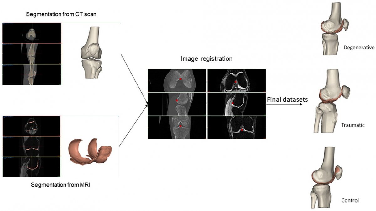 Publication Toward New Assessment of Knee Cartilage Degeneration SINPAIN