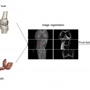 Publication: Toward New Assessment of Knee Cartilage Degeneration